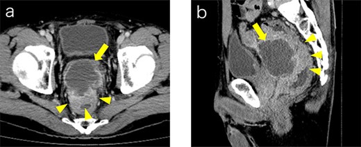 Contrast medium-enhanced CT upon admission in axial (a) and sagittal (b) sections. Irregular thickening of the rectal wall (arrowheads) and an accompanying pelvic abscess (arrows) are observed. No evident distant metastases are observed.