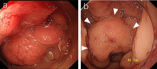 Sigmoid colonoscopy revealed a circular tumor in the upper rectum (a). Extramural compression due to an abscess is observed on the anal canal side of the tumor (arrowheads); however, the penetrated portion could not be detected (b).
