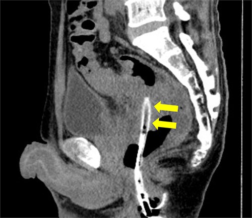 Pelvic CT performed 3 days after drainage in the sagittal section. Abscess cavity remarkably shrunk (arrowheads).