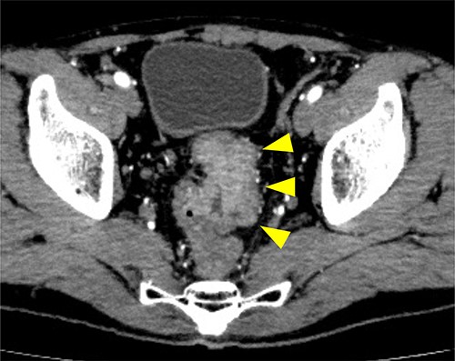 Preoperative CT examination one month after drainage. Thickening of the rectal wall is demonstrated (arrowheads); however, the pelvic abscess completely disappeared.