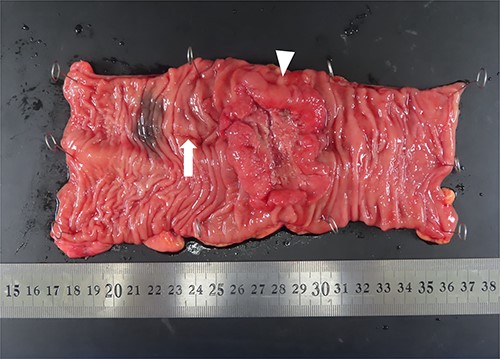 Macroscopic findings of the resected specimen. A circumferential tumor (arrowhead) and mucosal scar upon presenting the drainage route (arrow) are located in the rectum.