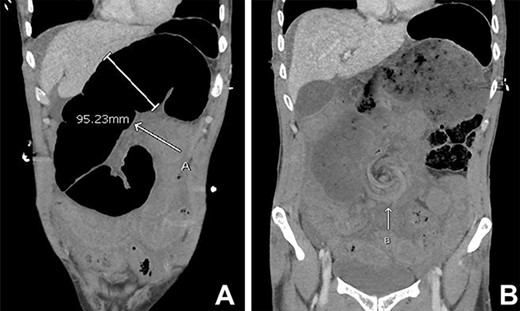 Initial CT abdomen pelvis with contrast in the portal venous phase showed (A) dilated small bowel and the (B) classical whirlpool sign.