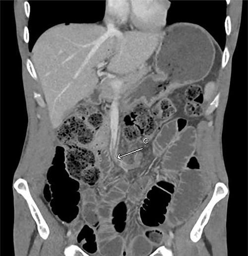 Repeat CT abdomen pelvis with contrast in the portal venous phase showed (C) filling defect in the superior mesenteric vein. Multiple dilated small bowel loops without a clear transition point were also evident, suggestive of ileus.