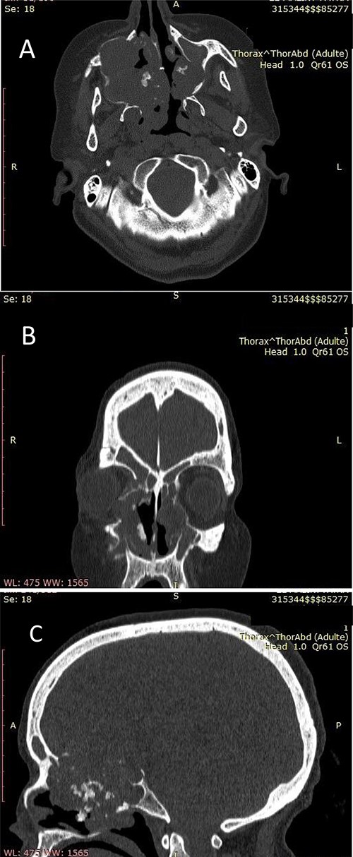 (A) Nasosinusal CT in axial section showing an isodense tissue process, located in the right maxillary sinus and the ipsilateral nasal cavity, extended to the right anterolateral wall of the cavum and to the contralateral nasal cavity after lysis of the nasal septum, with calcifications. (B) Nasosinusal CT in coronal section showing the extension of the tumor process to ethmoidal cells and to the right orbit after lysis of the papery lamina. (C) Nasosinusal CT in sagittal section showing the extension of the tumor process to the ethmoid–sphenoid complex and to the frontal sinuses.