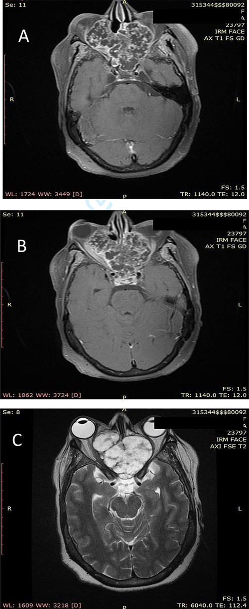 (A) Axial facial MRI in T1 sequence after Gadolinium injection showing a lobulated tissue process, occupying the nasal cavities, enhancing heterogeneous. (B) Axial facial MRI in T1 sequence after Gadolinium injection showing bilateral exophthalmos and a mass effect on the optic nerves. (C) Axial facial MRI in T2 sequence showing endocranial extension opposite the frontal lobes.