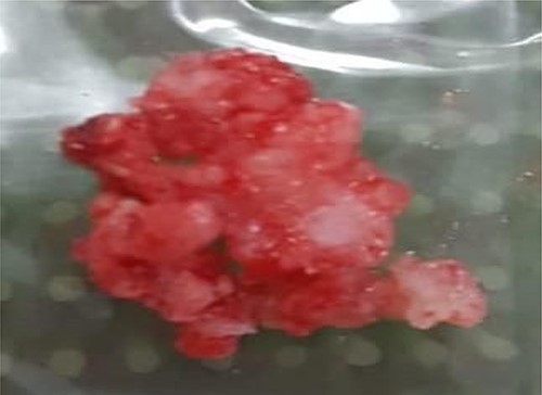 Surgical specimen with cartilage tissue.