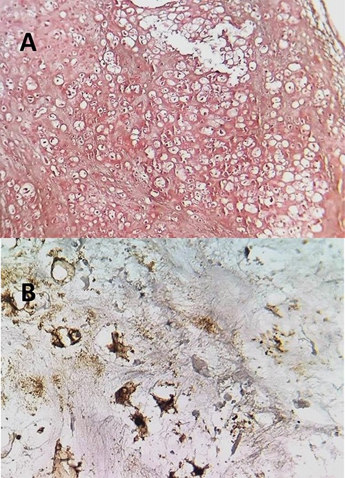 (A) The histopathological analysis showing moderately cellular chondrocyte proliferation on a cartilaginous background. Few mitotic figures have been observed. HE; ×100. (B) neoplastic cells express the S100 protein.