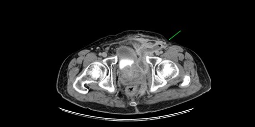 CT of the lower pelvis; supralevator abscess, with extension upward in touch with the left ilio-femoral vessels. The abscess cavity is shown approaching the skin with a long fistulous tract containing liquid (pus) and gas bubbles (green arrow).