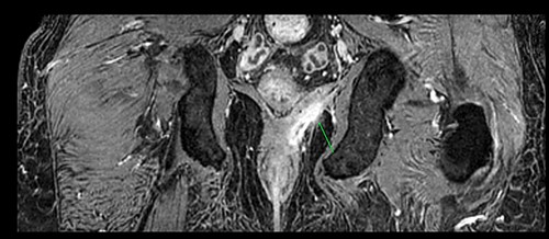 Pelvic MRI; left supralevator abscess (green arrow).