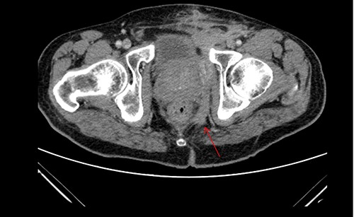 Postoperative CT of the lower pelvis, demonstrating a collapsed left supralevator space and superiorly expanding fistulous tract.