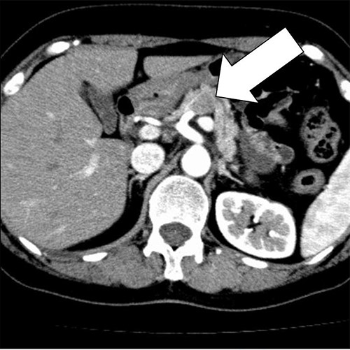 An abdominal CT scan revealed a 2 cm mass with mild contrast effect in the pancreatic body. There was a little tendency to invade the surrounding area, which was different from typical pancreatic ductal carcinoma.