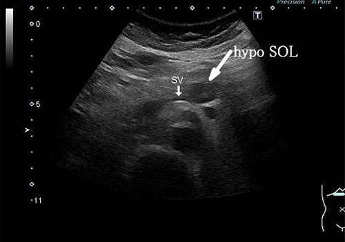 Abdominal US showed a 19.4 x 12.6 mm mass in the pancreatic body. It was a hypoechoic mass with a clear boundary, smooth and homogeneous interior. Pancreatic duct dilation was observed more clearly than around the mass.
