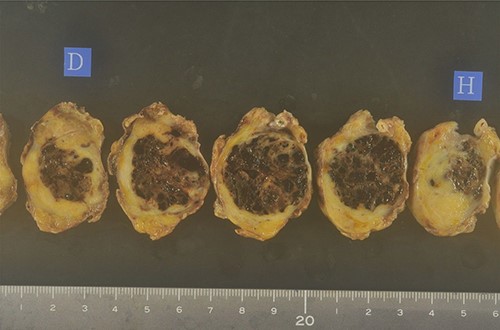 The resected body and tail of the pancreas had a nodular tumor measuring 30 mm in diameter, and cut surface revealed the tumor was surrounded by fibro adipose capsule-like tissue, and the central area was composed of follicular structures that contain brown red-colored fluid.