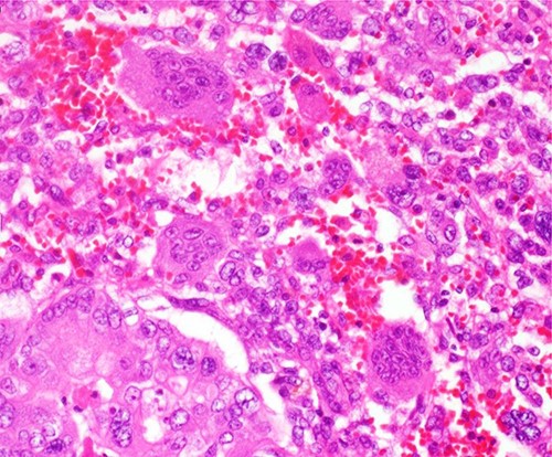The diffuse proliferation of atypical short spindle cells and round cells accompanied by multinucleated giant cells aggregation was observed around the tubular structure. The giant cells had multiple small round nuclei which gather in the centrocytic portion, resembling OCGCs.