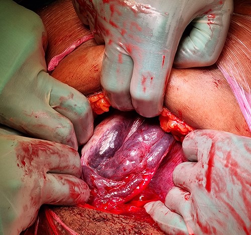 Per-operative diagnosis of uterine levotorsion: right adnexal view with congestion of the para-uterine vascular plexus.