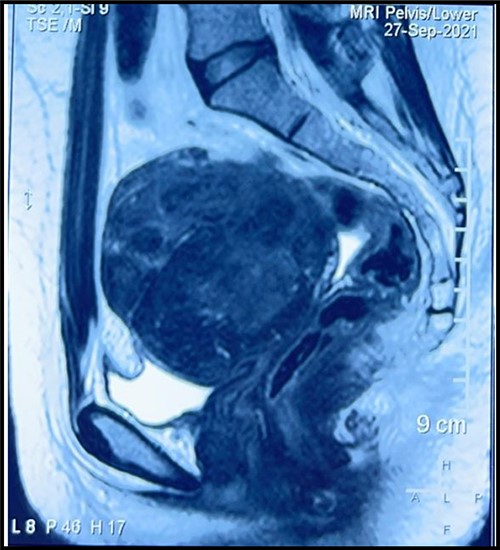 MRI image showing leiomyoma.