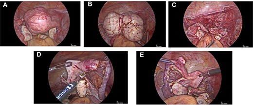 (A) Intra-operative images showing leiomyoma arising from right uterine horn. (B) Intra-operative images showing myoma dissected out of lateral pelvic wall. (C) Intra-operative images showing Mullerian buds after removal of myoma. (D) Intra-operative images showing removal of right uterine bud. (E) Intra-operative images showing small myoma in connective tissue between fallopian tube and uterine horn.