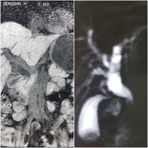MRCP showing dilation of common bile duct extending intrahepatically.