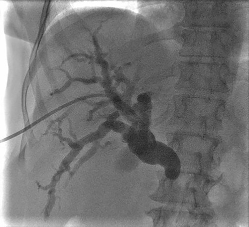 PTC showing dilation of intrahepatic biliary tree with abnormal tapering in the mid bile duct and lack of contrast filling distally.