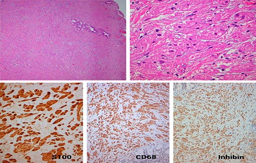 (A) Neoplastic growth of a poorly defined tumor with diffuse architecture in the fibromascular layer of the bile duct, with no signs of mucosal invasion or intraluminal extension (HE ×40); (B) the tumor is composed of polygonal cells with mild nuclear atypia and abundant granular eosinophilic cytoplasm separated by thin collagen bundles (HE ×400); (C) the tumor cells exhibit strong nuclear and diffuse cytoplasmic expression S100 protein (×200); (D) strong and diffuse cytoplasmic expression of CD68 (×100); (E) strong and diffuse cytoplasmic expression of Inhibin (×100).