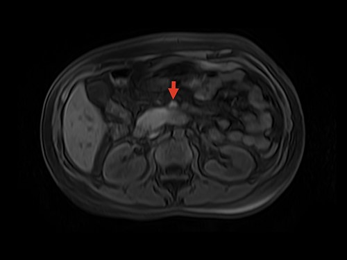 MRI showing superior mesenteric vein thrombus. Arrow: superior mesenteric vein with thrombus inside the vein lumen.