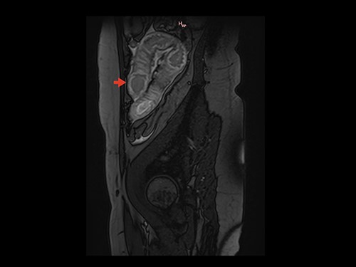 Sagittal section on MRI showing parietal thickening of the intestinal wall. Arrow: thickened intestinal wall.