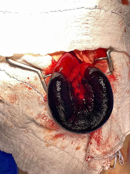 Laparotomy with exposure of the ischemic intestinal loop; resection was performed followed by end-to-end manual anastomosis.