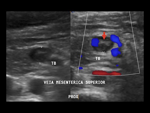 Doppler ultrasound showing superior MVT. Arrow: mesenteric vein thrombus.