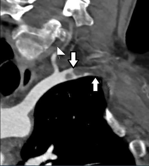 CT angiogram demonstrating location of the thoracic outlet obstruction (up arrow) and retrograde thrombosis (down arrow).