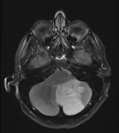 T2 sequence magnetic resonance imaging demonstrating large left cerebellar ischaemic stroke.