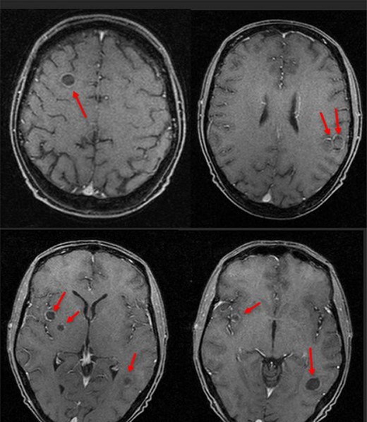 MRI scan after first seizure showing multiple brain abscesses.
