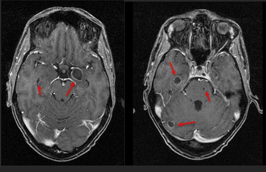 First MRI scan showing deeper brain abscesses.