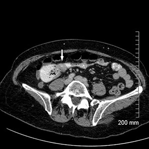 Axial cut of CT abdomen & pelvis demonstrating strictured segment of small bowel (white arrow).