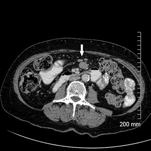 CT showing mesenteric lymphadenopathy (white arrow).
