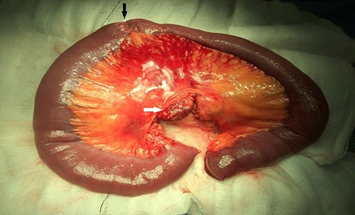 Resected specimen showing the tumour (black arrow) and a large mesenteric lymph node (white arrow).