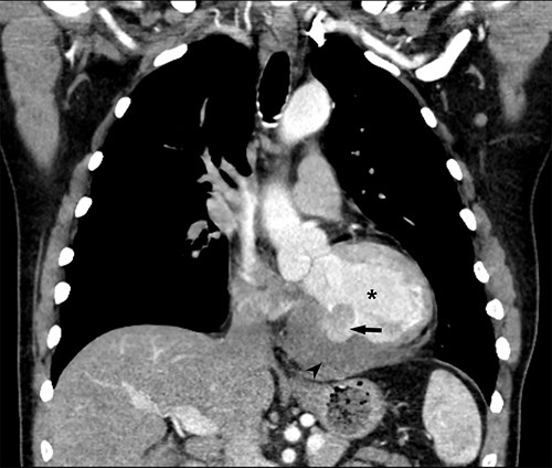 Coronal CT demonstrating left ventricular wall defect and intrapericardial thrombus; asterisk = left ventricular cavity, arrow = left ventricle free wall defect, arrowhead = thrombus.