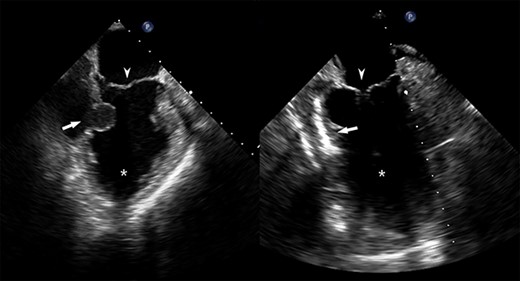 Pre- and post-repair transesophageal echocardiography images; leftward image: asterisk = left ventricular cavity, arrow = ventricular wall defect, arrowhead = mitral valve; rightward image: asterisk = left ventricular cavity, arrow = ventricular wall patch closure, arrowhead = mitral valve.