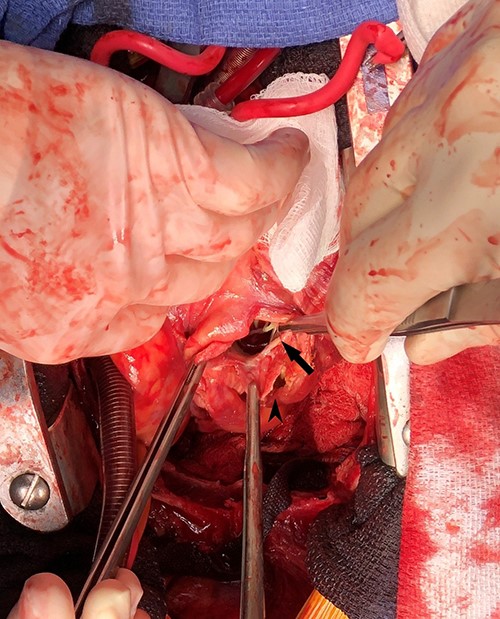 Intraoperative photograph demonstrating left ventricular wall defect; the heart is oriented with the apex retracted cephalad; arrow = left ventricular wall and mitral valve chordae, arrowhead = pseudoaneurysm wall.