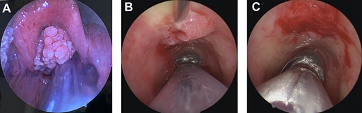 Intraoperative images. (A) Large, supraglottic, papillomatous lesion extending to petiole—excised at first surgery. (B) Tracheal papilloma being injected with Cidofovir at the base of lesion during second procedure. (C) Tracheal papilloma post debridement and injection of Cidofovir during the second procedure.
