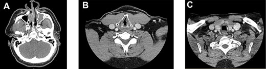 Imaging. (A) Complete opacification of the left maxillary sinus. There is also destruction of the nasal septum, which is consistent with post-operative changes. (B) A 2 mm nodular thickening of the left vocal cord. (C) A 2 mm thickening of the anterior trachea, consistent with intraoperative findings in the first procedure. This lesion was treated with debridement and Cidofovir in the second procedure.