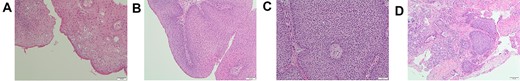 Histopathology. (A) Haematoxylin and eosin staining of supraglottic lesion showing squamous mucosa with scattered cells with enlarged, hyperchromatic nuclei, some with perinuclear haloes (possible HPV effect) (Light microscopy, ×10). (B) Haematoxylin and eosin staining of left nasal lesion demonstrating transitional epithelium with focal intraepithelial neutrophilic infiltrate (Light microscopy, ×10). (C) Haematoxylin and eosin staining of left nasal airway lesion showing inverted sinonasal papilloma, transitional epithelium with occasional goblet cells (Light microscopy, ×20). (D) Haematoxylin and eosin staining of left lateral nasal wall lesion showing sinonasal mucosa partly involved by inverted sinonasal papilloma (Light microscopy, ×10).