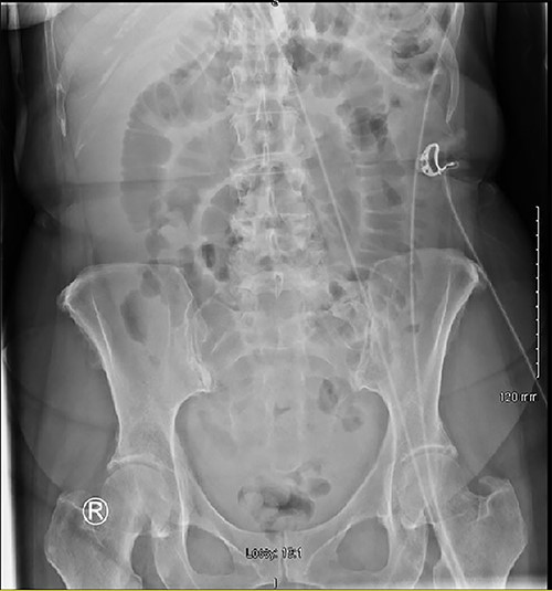 X-ray showing dilated small bowel loops.