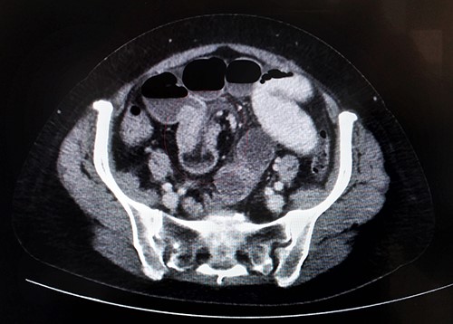 Axial section of abdominal CT scan showing bowel within bowel configuration with a layering effect indicating the site of ileal intussusception.