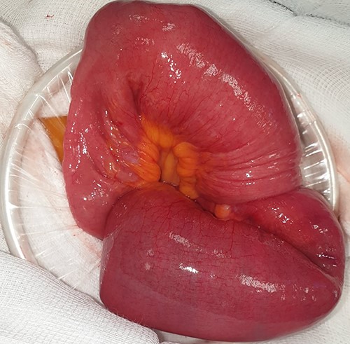 Ileal segment showing the site of intussusception at operation.