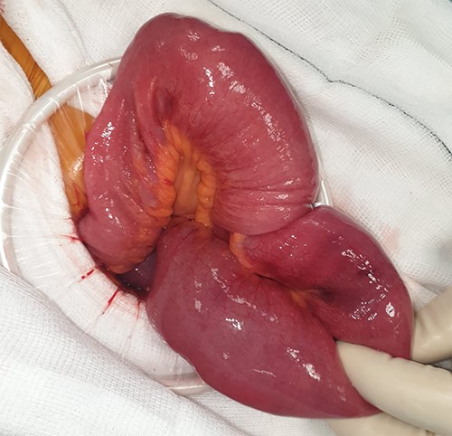 Manual reduction being attempted at operation.