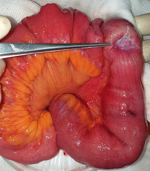 Tumour-like mass being shown at the lead point after reduction.