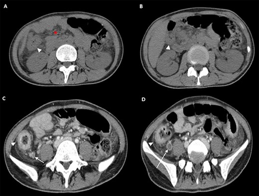 CT scan of the Abdomen obtained at this presentation. Transverse CT images (Panel A and B), obtained before administration of intravenous contrast material, show increased densification of adipose tissue (asterisk) along the whole colon, the cecum and part of the ascendant, which had thickened walls (arrowheads). Transverse CT images (Panel C and D), obtained after administration of intravenous contrast material, show the mucosa enhancement and submucosa edema due to flogosis (arrowheads), locoregional lymphoglandular also partially colliquate (arrows).