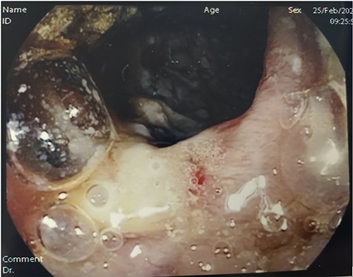 Colonoscopy. Digital photograph from optical colonoscopy shows the endoscopic capture of suffering and ischemic mucosa with deep fibrin-coated ulcers.