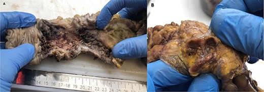 Operating pieces. Panel A shows right colon with a subverted mucosa; in particular, the blackish color indicates a suffering and ischemic mucosa. Panel B shows dissected pathological lymph node on which TBC diagnosis was made.