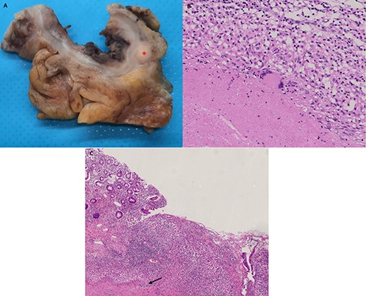 Histopathology of operative specimen. Panel A shows operating piece fixed with formalin: in panel A a large lymph node touched by disease is visible (asterisk). Panel B shows typical TB granuloma with caseation necrosis, lymphocytes, macrophages and also Giant cells. Panel C shows ulcer covered with fibrin and under granulation tissue. Under ulcer, there is caseation necrosis (arrow). Endoscopist should have to perform biopsies here to increase exam sensitivity.